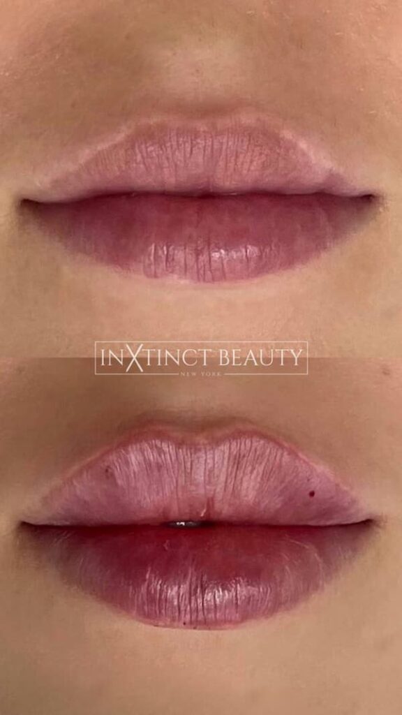 Russian Lip Technique Lip Augmentation, Lip Filler NYC