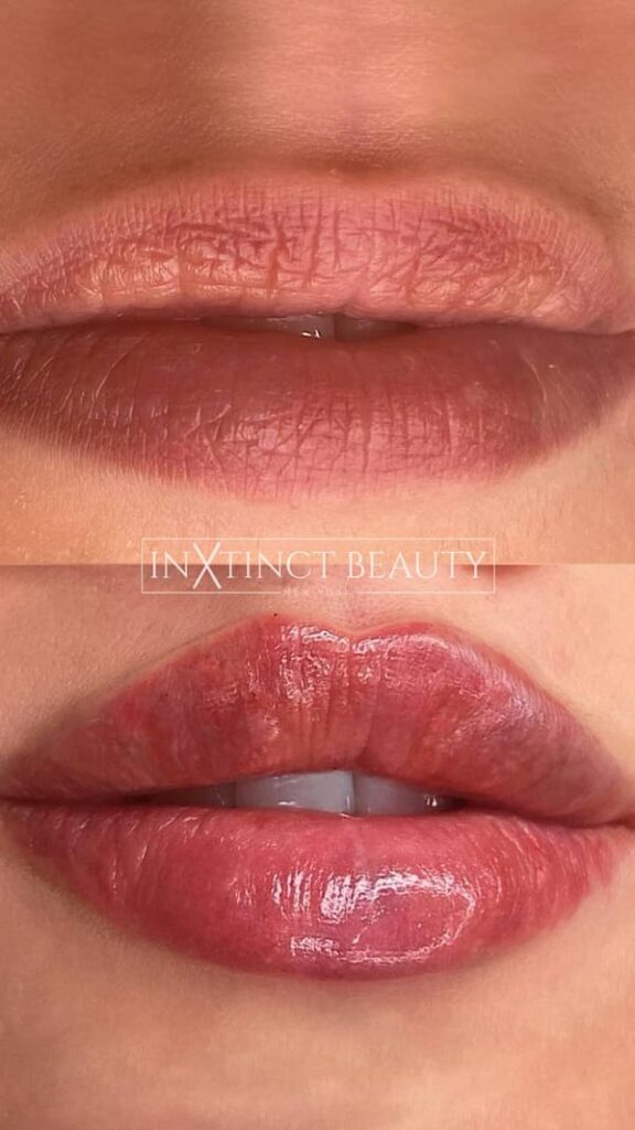 Russian Lip Technique Lip Augmentation, Lip Filler NYC
