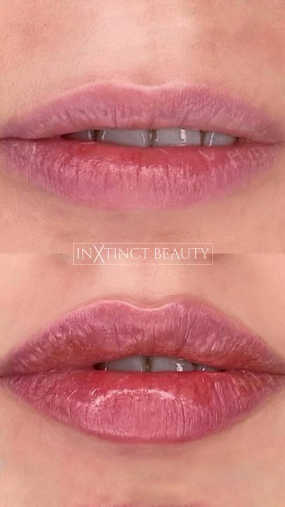 Russian Lip Technique Lip Augmentation, Lip Filler NYC