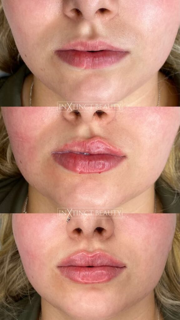 Russian Lip Technique Lip Augmentation, Lip Filler NYC